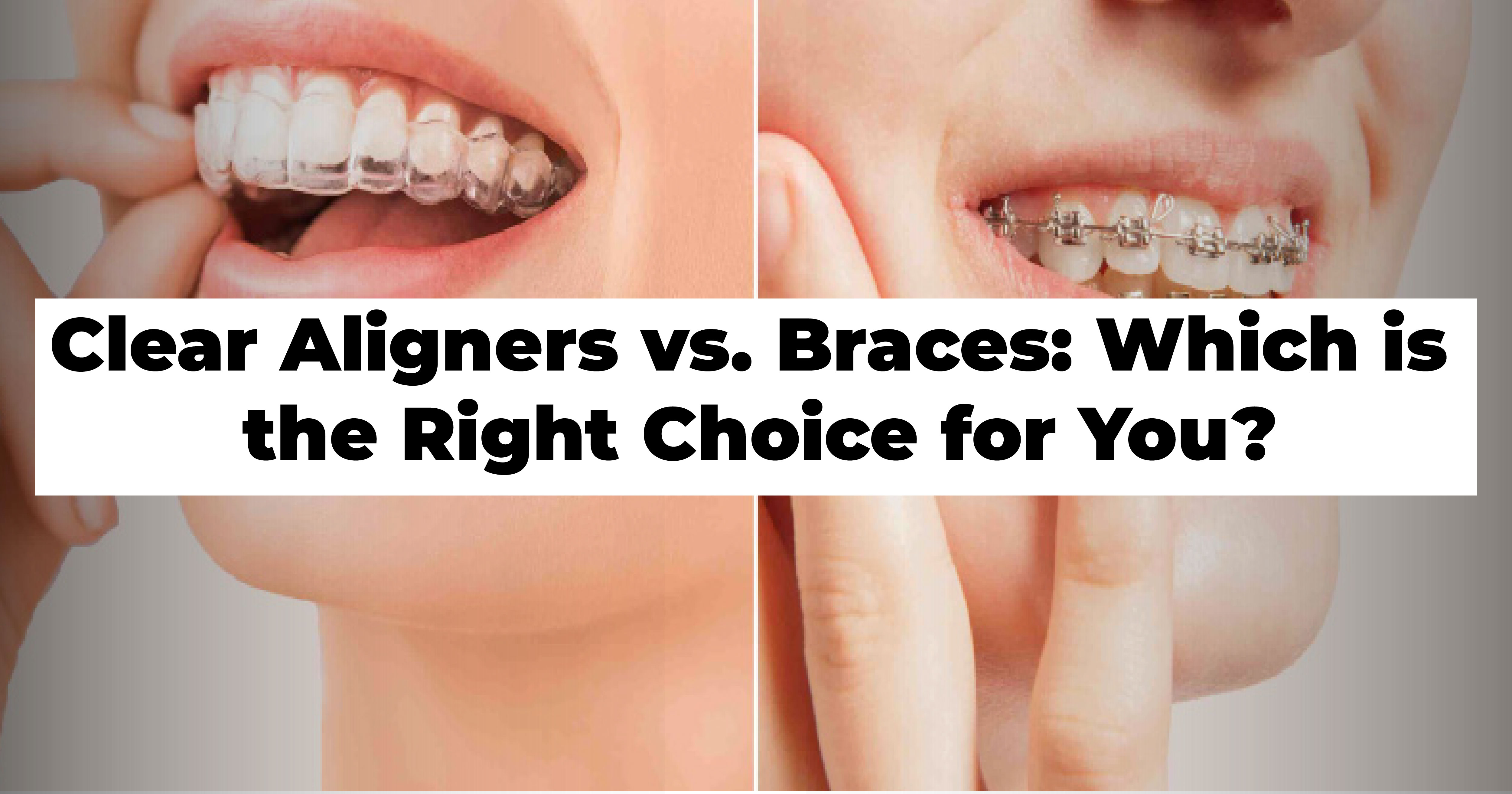 https://venunaddental.com.lttrbx.in/uploaded_file/files/img/news/Clear Aligners vs. Braces
